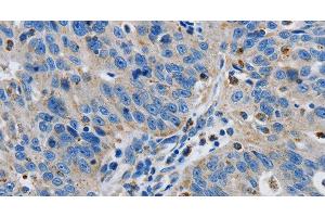 Immunohistochemistry of paraffin-embedded Human ovarian cancer tissue using GRIA3 Polyclonal Antibody at dilution 1:50