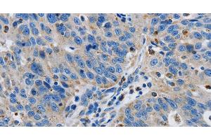 Immunohistochemistry of paraffin-embedded Human ovarian cancer tissue using GRIA3 Polyclonal Antibody at dilution 1:50 (Glutamate Receptor 3 anticorps)