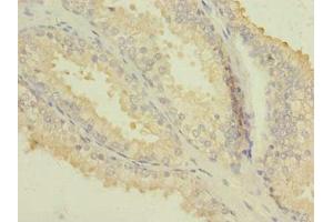 Immunohistochemistry of paraffin-embedded human prostate cancer using ABIN7163163 at dilution of 1:100