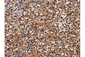 The image on the left is immunohistochemistry of paraffin-embedded Human prostate cancer tissue using ABIN7130450(NPM3 Antibody) at dilution 1/60, on the right is treated with fusion protein.