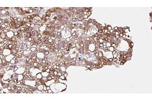 ABIN6272902 at 1/100 staining Human liver cancer tissue by IHC-P. (MPP5 anticorps  (C-Term))