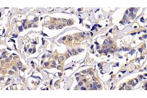 Detection of Bcl2L in Human Breast cancer Tissue using Polyclonal Antibody to B-Cell CLL/Lymphoma 2 Like Protein (Bcl2L)
