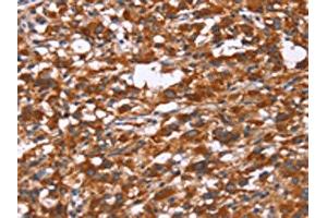 The image on the left is immunohistochemistry of paraffin-embedded Human thyroid cancer tissue using ABIN7190842(GPHN Antibody) at dilution 1/30, on the right is treated with synthetic peptide. (Gephyrin anticorps)