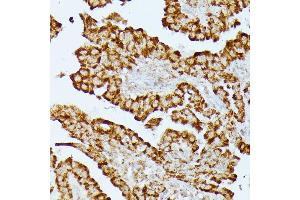 Immunohistochemistry of paraffin-embedded human thyroid cancer using HMGCS2 antibody (ABIN7265329) at dilution of 1:100 (40x lens). (HMGCS2 anticorps  (AA 269-508))