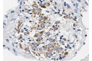 ABIN6267624 at 1/100 staining human lung carcinoma tissue sections by IHC-P.