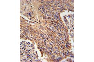 RDH10 Antibody immunohistochemistry analysis in formalin fixed and paraffin embedded lung carcinoma followed by peroxidase conjugation of the secondary antibody and DAB staining.