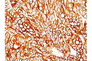 Formalin-fixed, paraffin-embedded human Colon Carcinoma stained with Cytokeratin 18 Mouse Monoclonal Antibody (DA7).