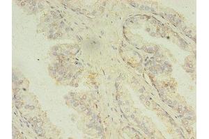 Immunohistochemistry of paraffin-embedded human prostate cancer using ABIN7159988 at dilution of 1:100 (MAPK13 anticorps  (AA 1-365))