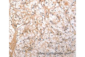 Immunohistochemistry of Human lung cancer using HCRTR1 Polyclonal Antibody at dilution of 1:100