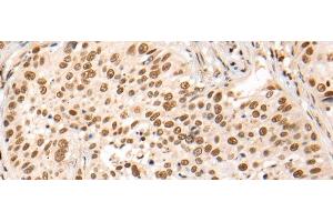 Immunohistochemistry of paraffin-embedded Human lung cancer tissue using HOXA7 Polyclonal Antibody at dilution of 1:70(x200) (HOXA7 anticorps)