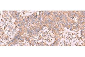 Immunohistochemistry of paraffin-embedded Human ovarian cancer tissue using EEF1D Polyclonal Antibody at dilution of 1:65(x200)