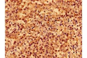 Immunohistochemistry of paraffin-embedded human colon cancer using ABIN7160238 at dilution of 1:100 (SMAD4 anticorps  (AA 27-195))