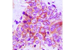 Immunohistochemical analysis of FOP staining in human breast cancer formalin fixed paraffin embedded tissue section.