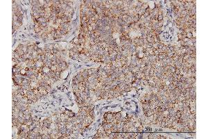 Immunoperoxidase of monoclonal antibody to PPOX on formalin-fixed paraffin-embedded human lung, adenosquamous cell carcinoma.
