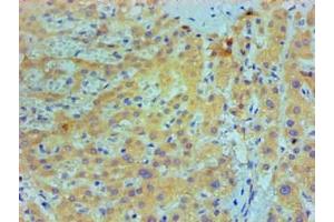 Immunohistochemical of paraffin-embedded Human live cancer tissue using ABIN7156047 at dilution of 1:200.