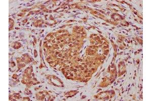 IHC image of ABIN7144920 diluted at 1:100 and staining in paraffin-embedded human pancreatic cancer performed on a Leica BondTM system.