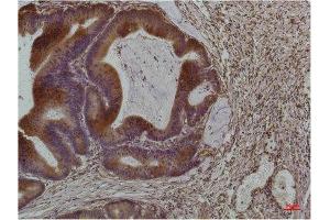 Immunohistochemistry (IHC) analysis of paraffin-embedded Human Colon Carcinoma using Smad3 Mouse Monoclonal Antibody diluted at 1:200. (SMAD3 anticorps)