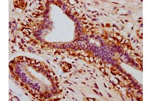 IHC image of ABIN7127754 diluted at 1:100 and staining in paraffin-embedded human breast cancer performed on a Leica BondTM system.