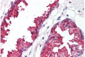 Human Prostate (formalin-fixed, paraffin-embedded) stained with BACE1 antibody ABIN213581 at 5 ug/ml followed by biotinylated goat anti-rabbit IgG secondary antibody ABIN481713, alkaline phosphatase-streptavidin and chromogen.