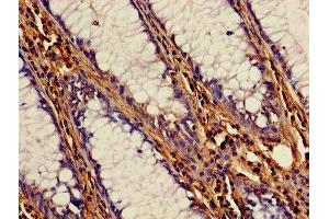 Immunohistochemistry of paraffin-embedded human colon cancer using ABIN7148987 at dilution of 1:100 (CSTB anticorps  (AA 1-98))