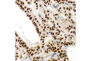 Immunohistochemistry of paraffin-embedded human thyroid cancer using MT2A antibody (ABIN1873764) at dilution of 1:200 (40x lens). (MT2A anticorps)