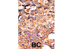 Formalin-fixed and paraffin-embedded human cancer tissue reacted with PANK3 polyclonal antibody  , which was peroxidase-conjugated to the secondary antibody, followed by AEC staining. (PANK3 anticorps  (Internal Region))