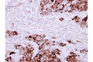 IHC-P Image Fibrinogen gamma antibody detects FGG protein at cytosol on human breast cancer by immunohistochemical analysis.