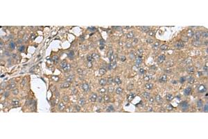 Immunohistochemistry of paraffin-embedded Human liver cancer tissue using EIF4A2 Polyclonal Antibody at dilution of 1:65(x200)