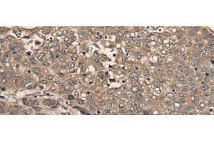 Immunohistochemistry of paraffin-embedded Human liver cancer tissue using CDC20B Polyclonal Antibody at dilution of 1:30(x200)