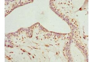 Immunohistochemistry of paraffin-embedded human breast cancer using ABIN7158965 at dilution of 1:100
