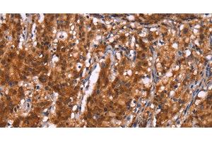Immunohistochemistry of paraffin-embedded Human gastric cancer using BRK1 Polyclonal Antibody at dilution of 1:40 (BRK1 anticorps)