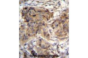 TTC9C Antibody (N-term) immunohistochemistry analysis in formalin fixed and paraffin embedded human breast carcinoma followed by peroxidase conjugation of the secondary antibody and DAB staining. (TTC9C anticorps  (N-Term))