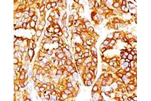 Formalin-fixed, paraffin-embedded human melanoma stained with MART-1 antibody (SPM540).