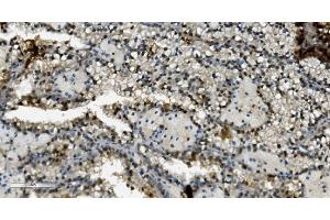 IHC analysis of Transketolase/TKT using anti-Transketolase/TKT antibody (ABIN7598958). (TKT anticorps  (AA 1-116))