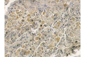 ABIN6257230 and ABIN6273665 at 1/100 staining human lung squamous cell carcinoma by IHC-P. (IFNAR2 anticorps  (C-Term))