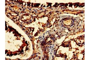 Immunohistochemistry of paraffin-embedded human lung tissue using ABIN7147484 at dilution of 1:100 (CDR2 anticorps  (AA 1-454))