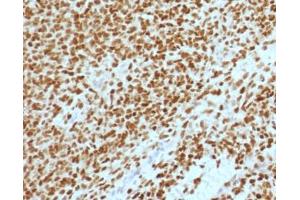 IHC testing of FFPE Ewings sarcoma with NKX2. (Nkx2-2 anticorps  (AA 1-119))
