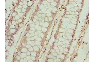 Immunohistochemistry of paraffin-embedded human colon cancer using ABIN7152907 at dilution of 1:100 (FSIP1 anticorps  (AA 101-400))
