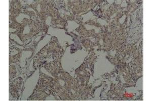 Immunohistochemistry (IHC) analysis of paraffin-embedded Human Breast Carcicnoma using c-Fos Mouse Monoclonal Antibody diluted at 1:200. (c-FOS anticorps)