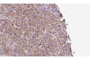 ABIN6273185 at 1/100 staining Human lymph cancer tissue by IHC-P. (WBP2NL anticorps  (Internal Region))