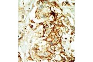Formalin-fixed and paraffin-embedded human cancer tissue (breast carcinoma) reacted with the primary antibody, which was peroxidase-conjugated to the secondary antibody, followed by DAB staining. (MAPK10 anticorps  (N-Term))