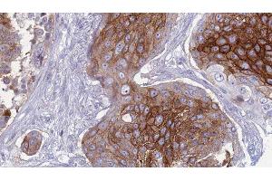 ABIN6277433 at 1/100 staining Human urothelial cancer tissue by IHC-P. (SLC1A4 anticorps  (C-Term))