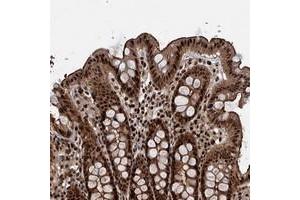 Immunohistochemical staining of human colon with ANKRD49 polyclonal antibody  shows strong nuclear, cytoplasmic and membranous positivity in glandular cells. (ANKRD49 anticorps)