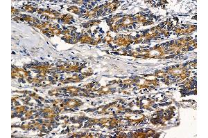 ABIN6257349 and ABIN6274728 at 1/100 staining human colorectal cancer by IHC-P.