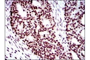 Immunohistochemical analysis of paraffin-embedded ovarian cancer tissues using WHSC2 mouse mAb with DAB staining. (WHSC2 anticorps  (AA 280-511))