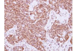 IHC-P Image Immunohistochemical analysis of paraffin-embedded human lung adenocarcinoma, using Cyclin A2, antibody at 1:250 dilution. (Cyclin A anticorps  (C-Term))