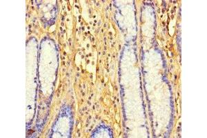 Immunohistochemistry of paraffin-embedded human gastric cancer using ABIN7165770 at dilution of 1:100 (LTV1 anticorps  (AA 201-475))