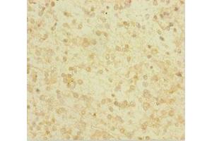 Immunohistochemistry of paraffin-embedded human glioma using ABIN7154046 at dilution of 1:100