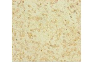 Immunohistochemistry of paraffin-embedded human glioma using ABIN7154046 at dilution of 1:100 (Glutaredoxin 1 anticorps  (AA 1-106))