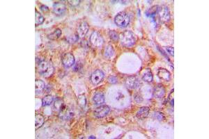 Immunohistochemical analysis of Caspase 1 staining in human lung cancer formalin fixed paraffin embedded tissue section. (Caspase 1 anticorps  (Center))